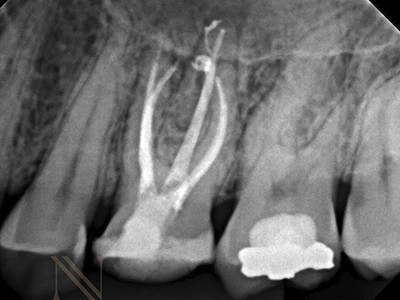 Radiografia final — dente 26