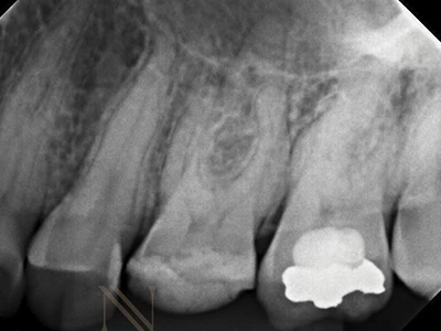 Radiografia inicial — dente 26