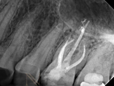 Radiografia em proservação — dente 26