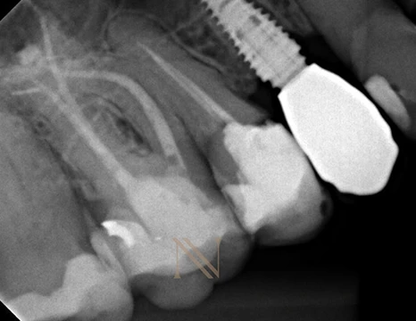 Radiografia final — dente 16