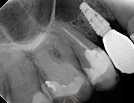 Radiografia inicial — dente 16
