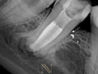 Radiografia final — dente 47