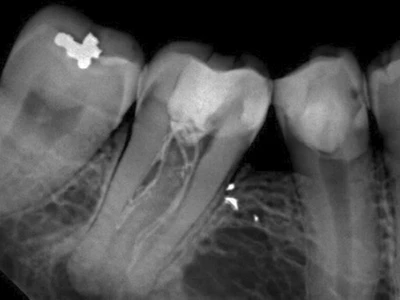 Radiografia inicial — dente 47