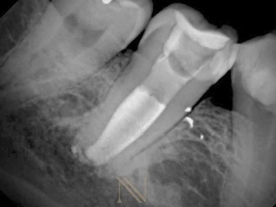 Radiografia em proservação — dente 47