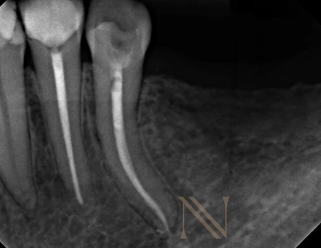 Radiografia final — dente 35