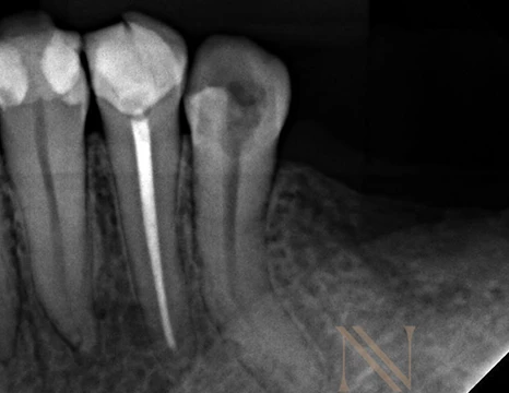 Radiografia inicial — dente 35