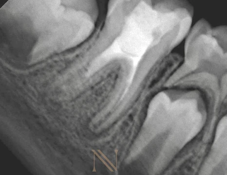 Radiografia final — dente 46