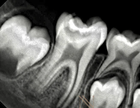 Radiografia inicial — dente 46