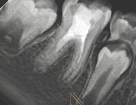 Radiografia em proservação — dente 46